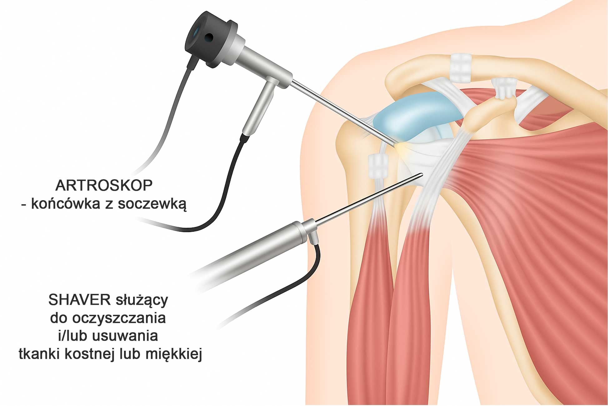 Artroskopia barku – nowoczesna metoda leczenia, jedna z lepszych na ból barku przy podnoszeniu ręki