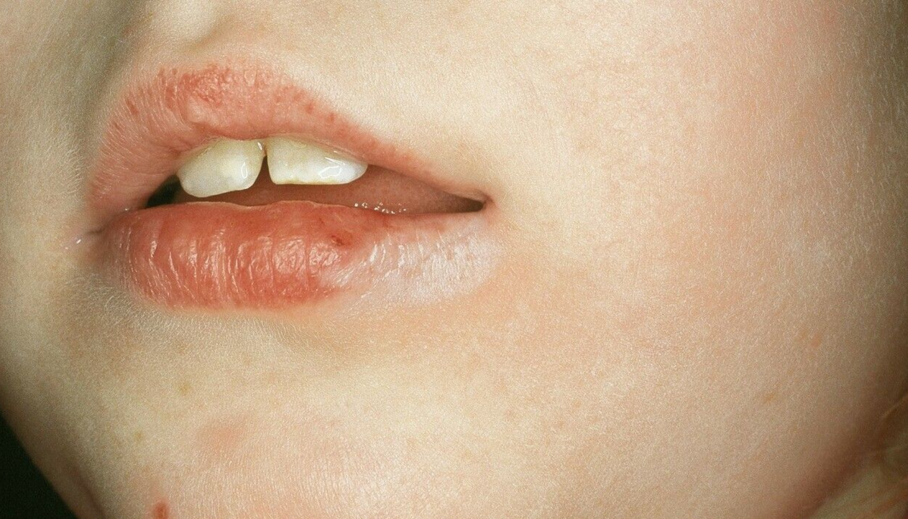 Barn med tørre, sprukne lepper og sår i munnviken som kan tyde på cheilitt.