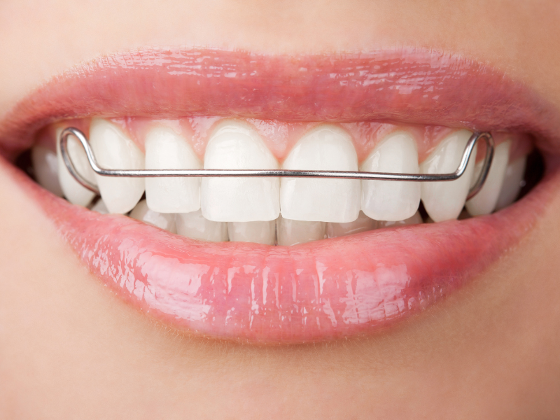 An image of someone smiling with metal retainers for their upper and lower teeth.