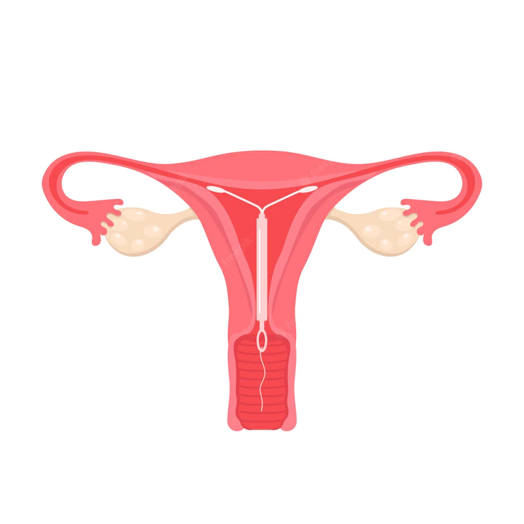                  An intrauterine device is placed inside the uterus by a trained health professional.