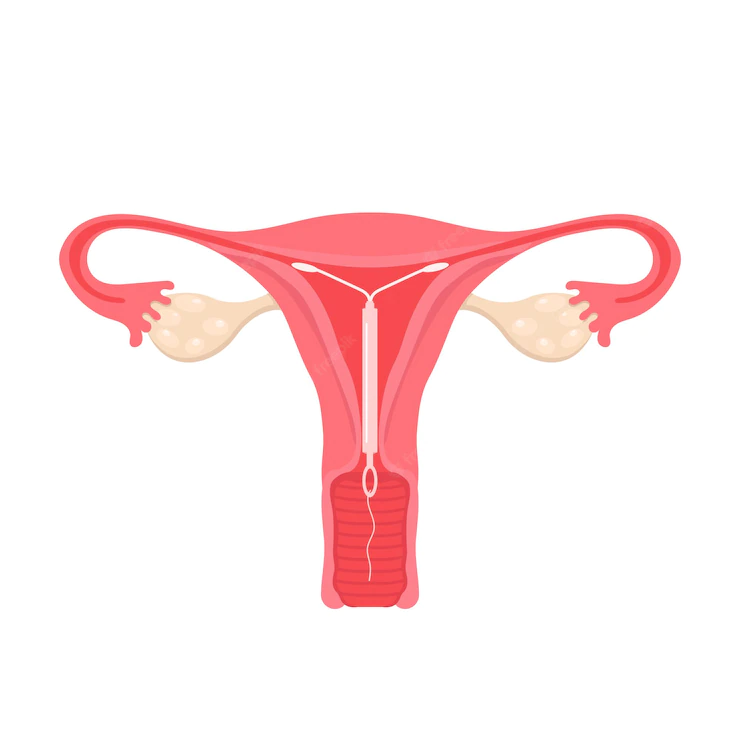                  Een intra -uterien apparaat wordt in de baarmoeder geplaatst door een getrainde gezondheidsster.