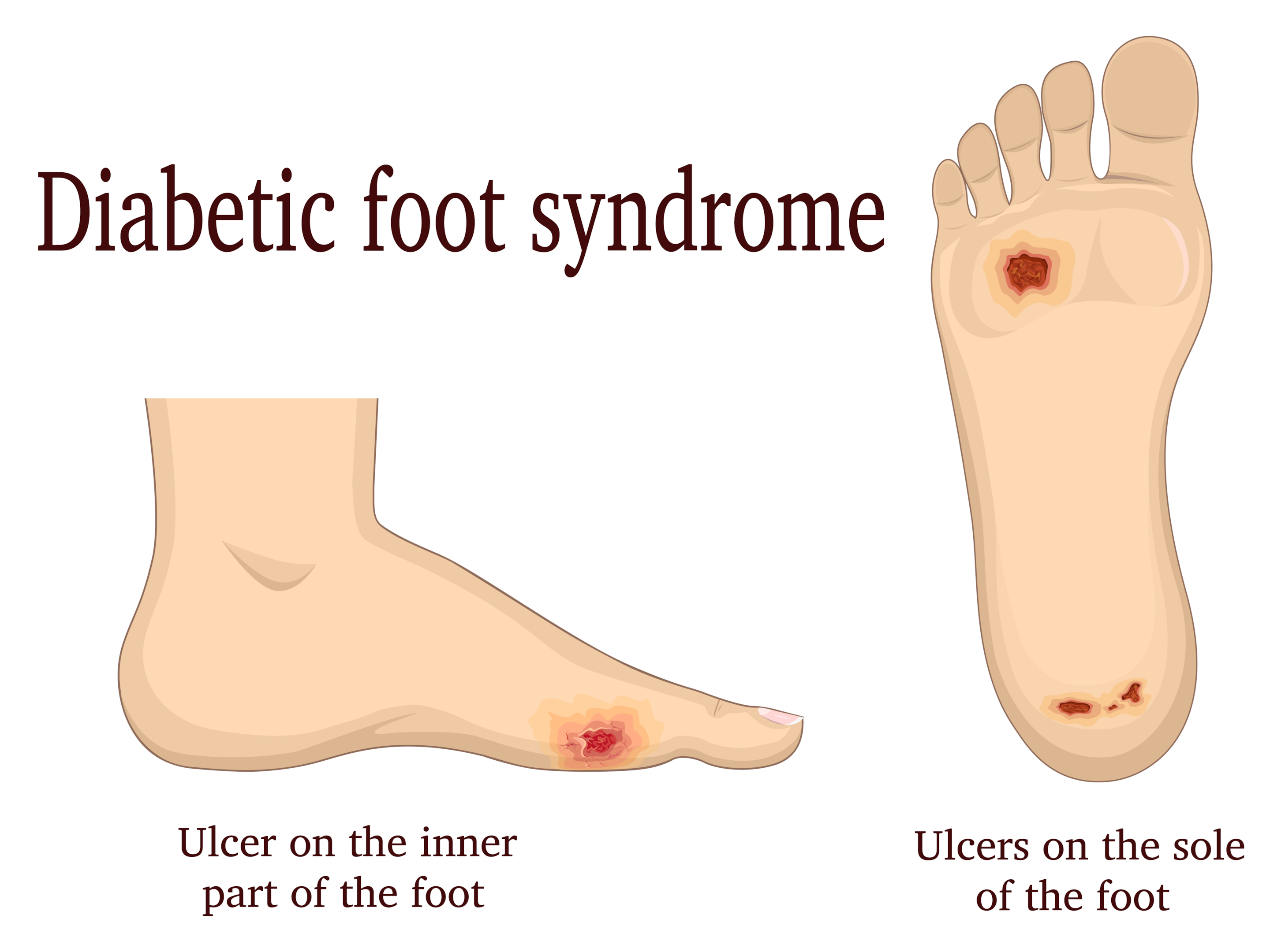 diabetes affects foot temperature and can lead to ulcers