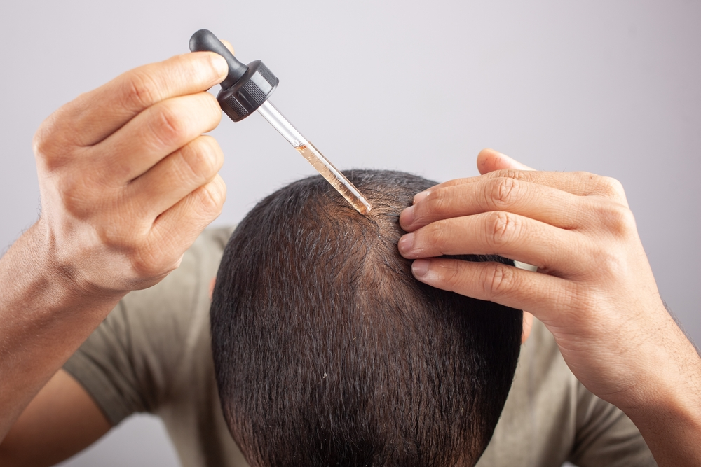 Man applying Minoxidil solution to the crown of his head
