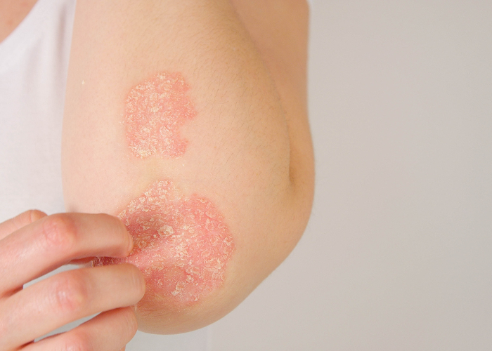 eccema, dermatitis atópica, manchas en la piel