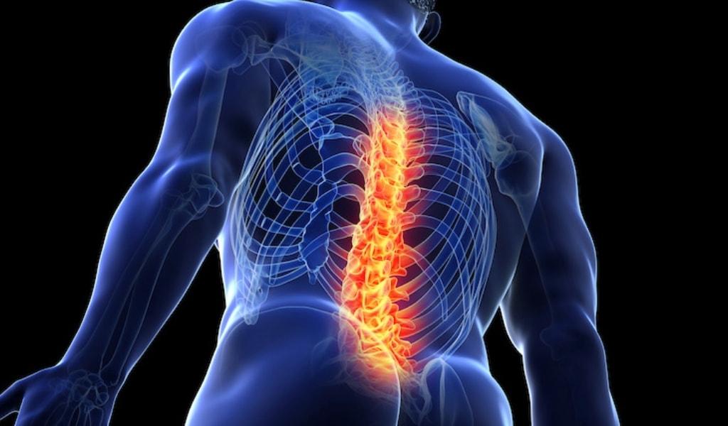 Image of a spinal cord injury