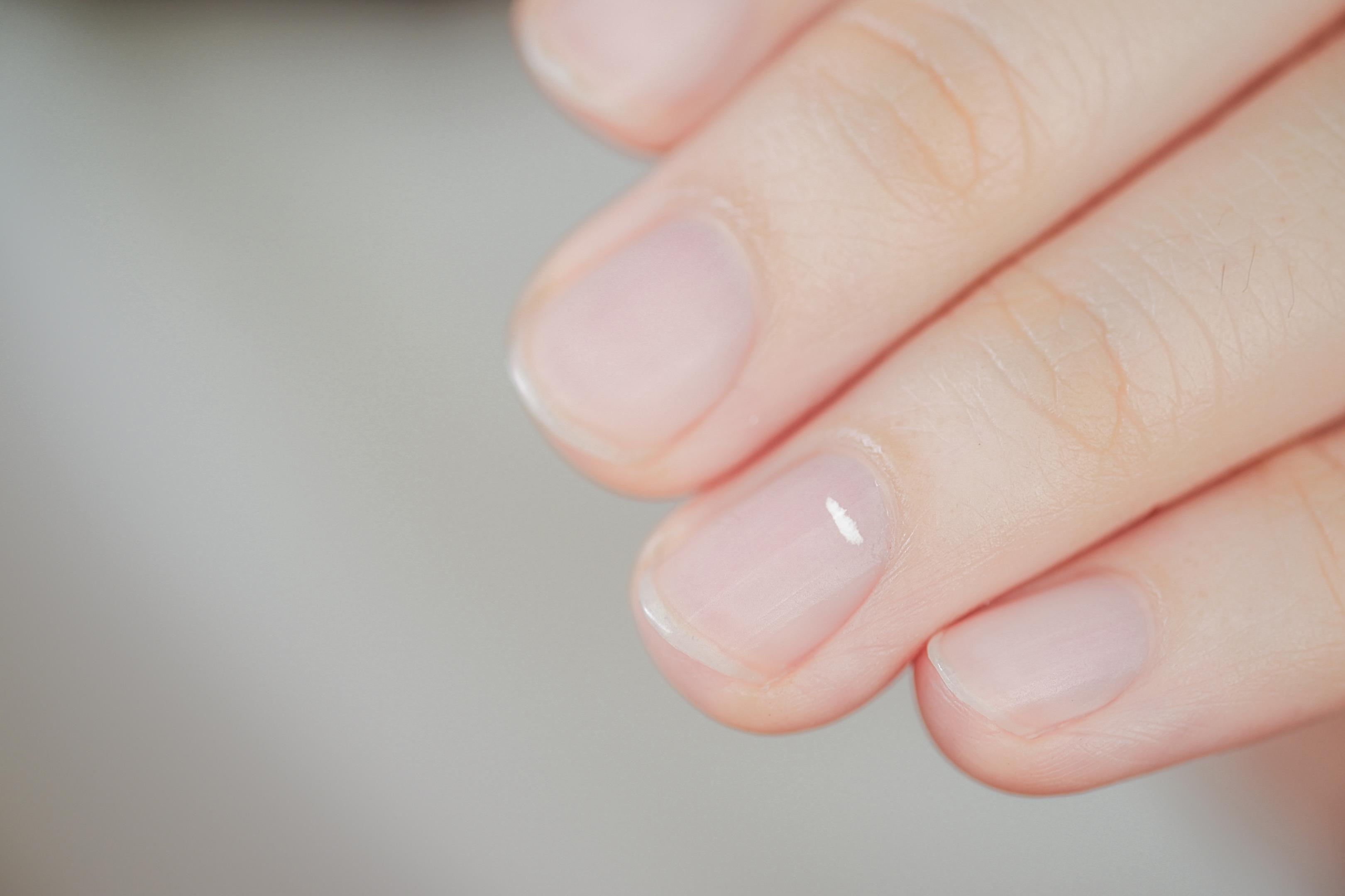 A female showing nails with white lines.