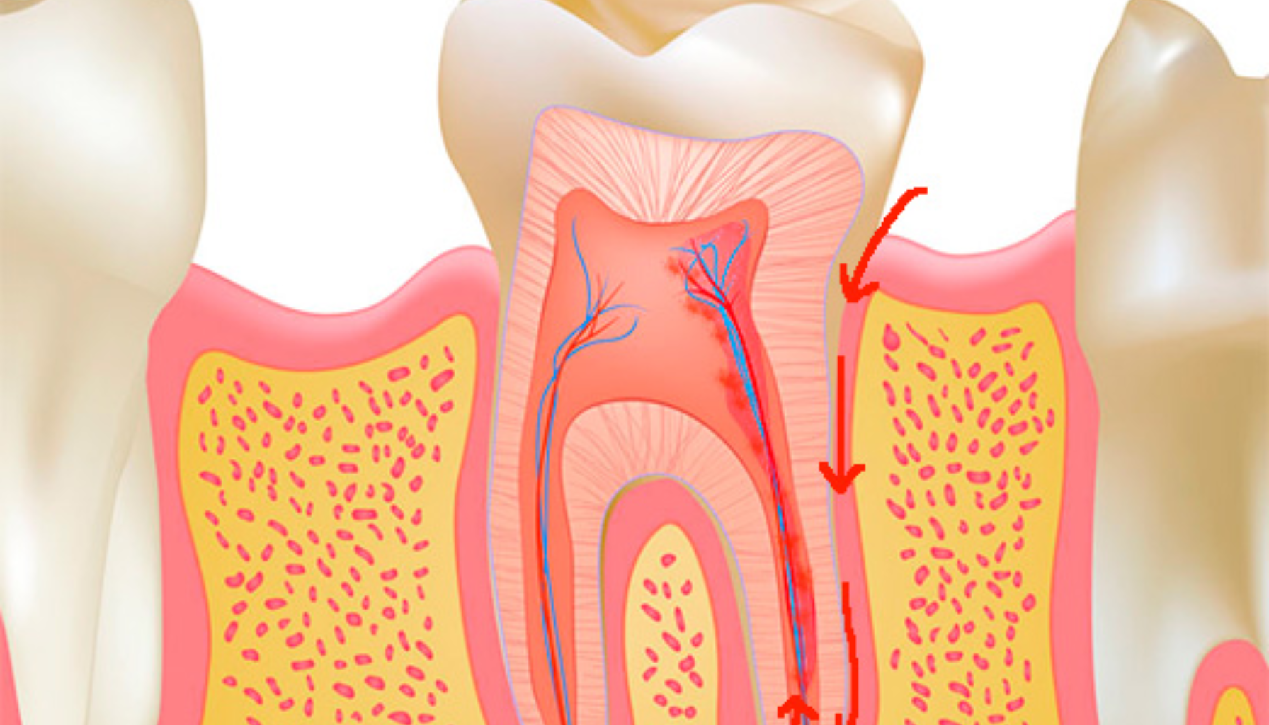 Pulpitt: Når Tannverken Betyr Alvor – Dette Må Du Vite 14 Illustrasjon av tann med nerver og blodårer, viser infeksjon som sprer seg nedover rotkanalen mot kjevebenet.