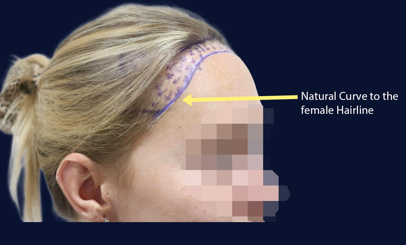 Dr Kunnure Clinic- Hair Transplant -Female Hairline