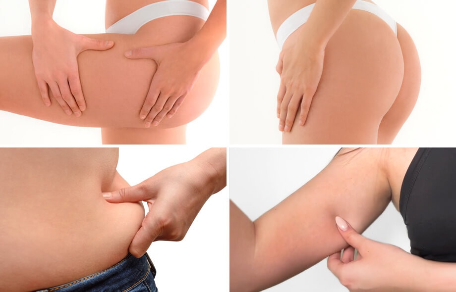 Varie donne che controllano le parti del corpo per esaminare se è presente la cellulite