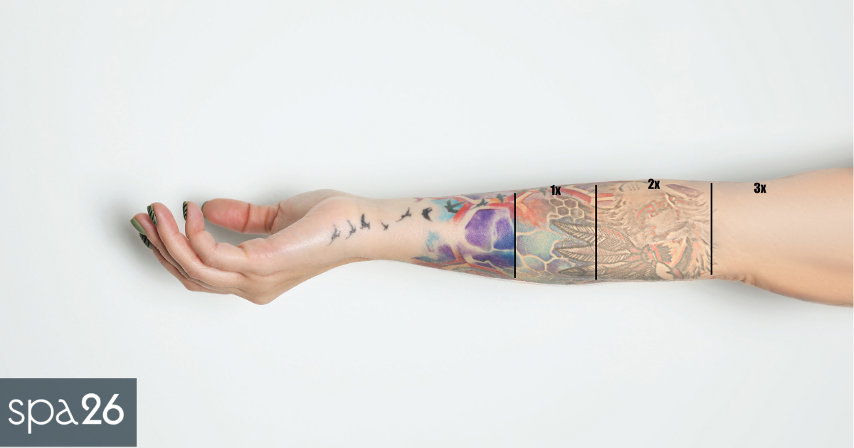 What to Expect After Laser Tattoo Removal