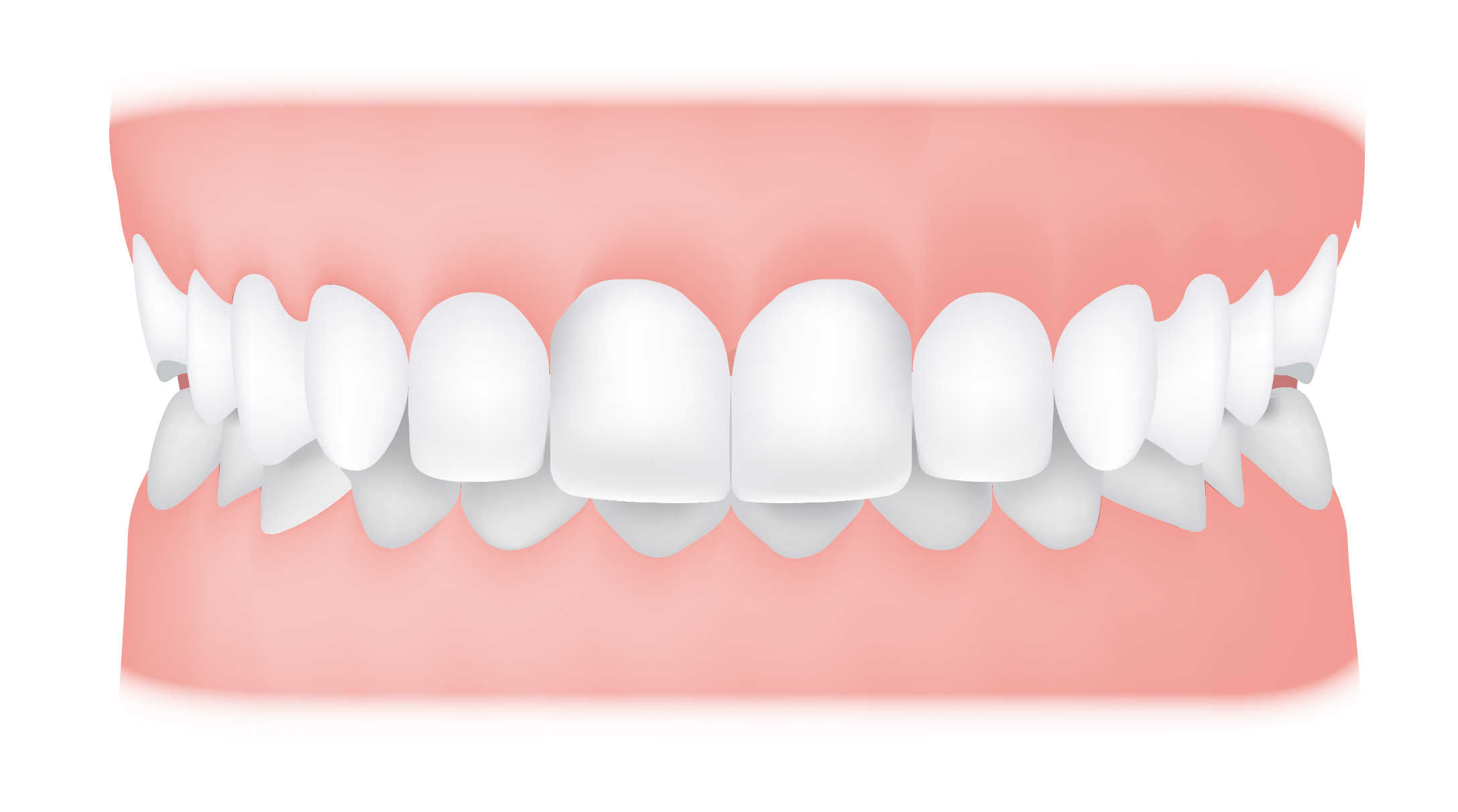 Overbite Here's Everything You Need To Know