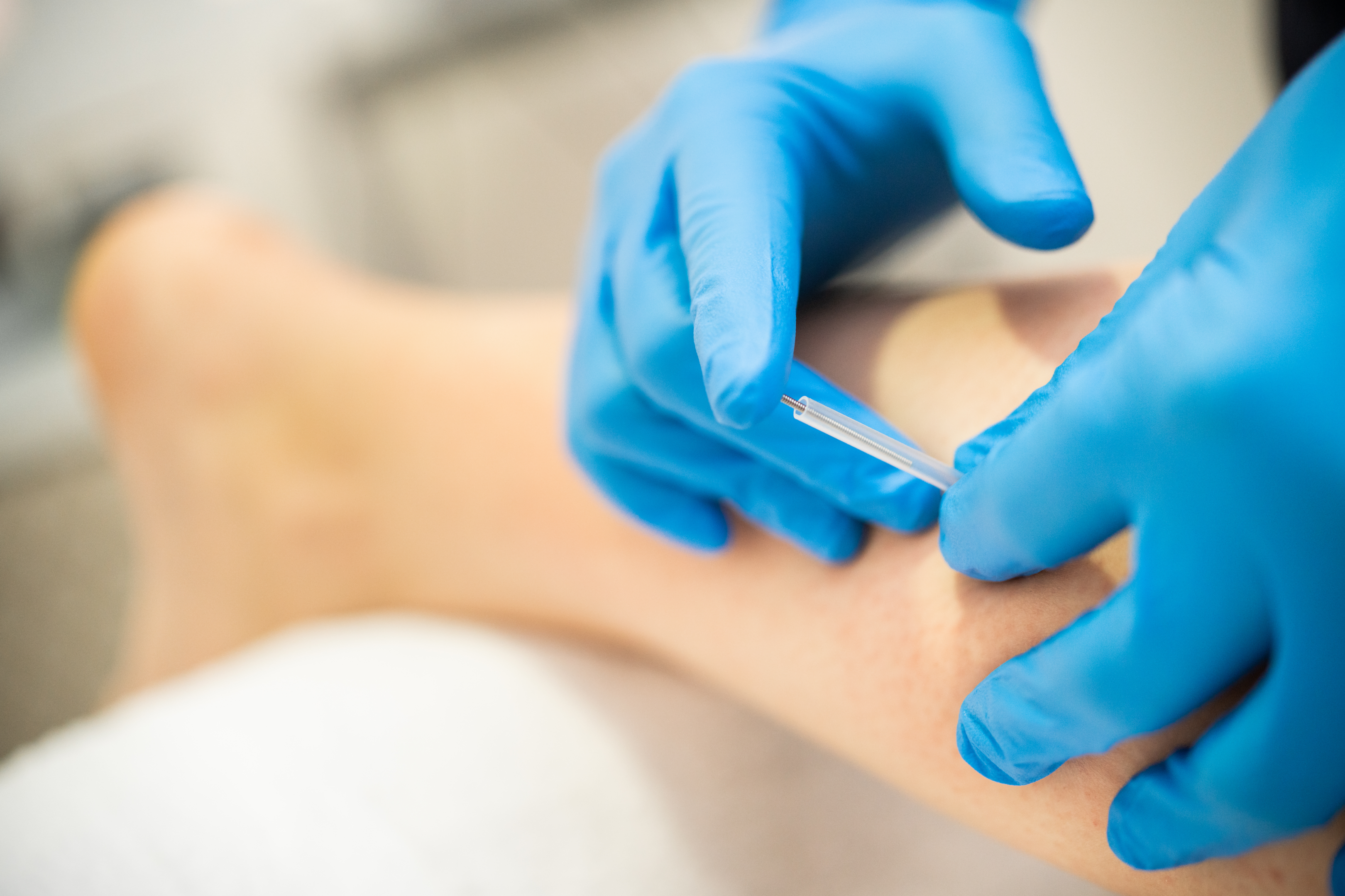 Difference between dry needling and acupuncture