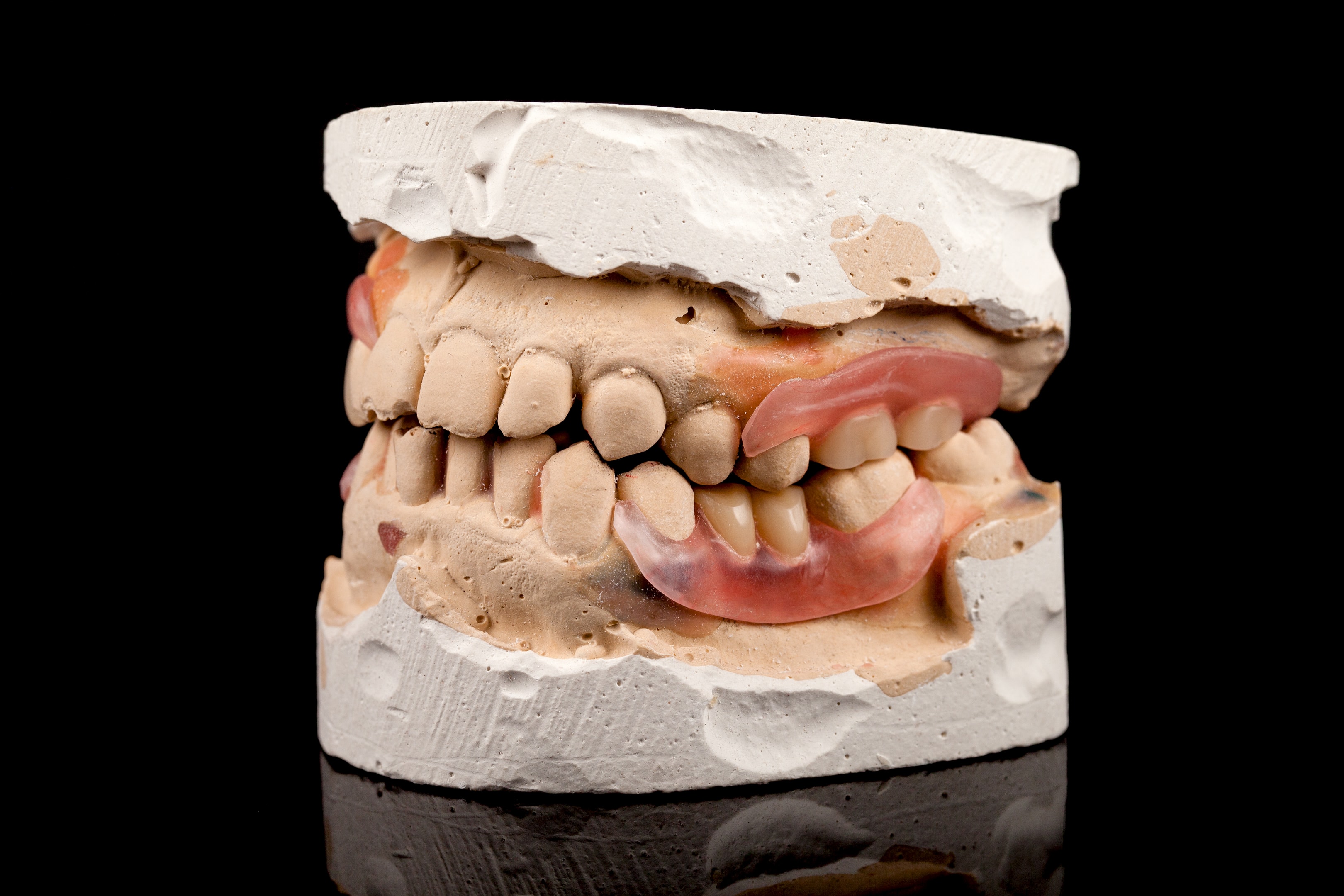 A facial skeleton of a teeth before orthognathic jaw surgery.