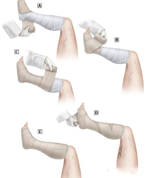 How To Properly Apply Bandage Compression Therapy Bka Med 2520