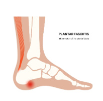 A person wearing a soft sock night splint for plantar fasciitis relief