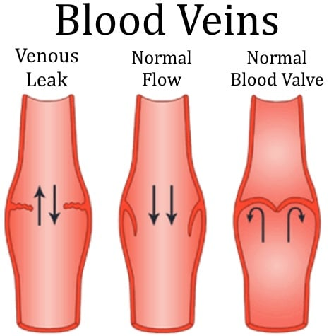 What is Venous Leak