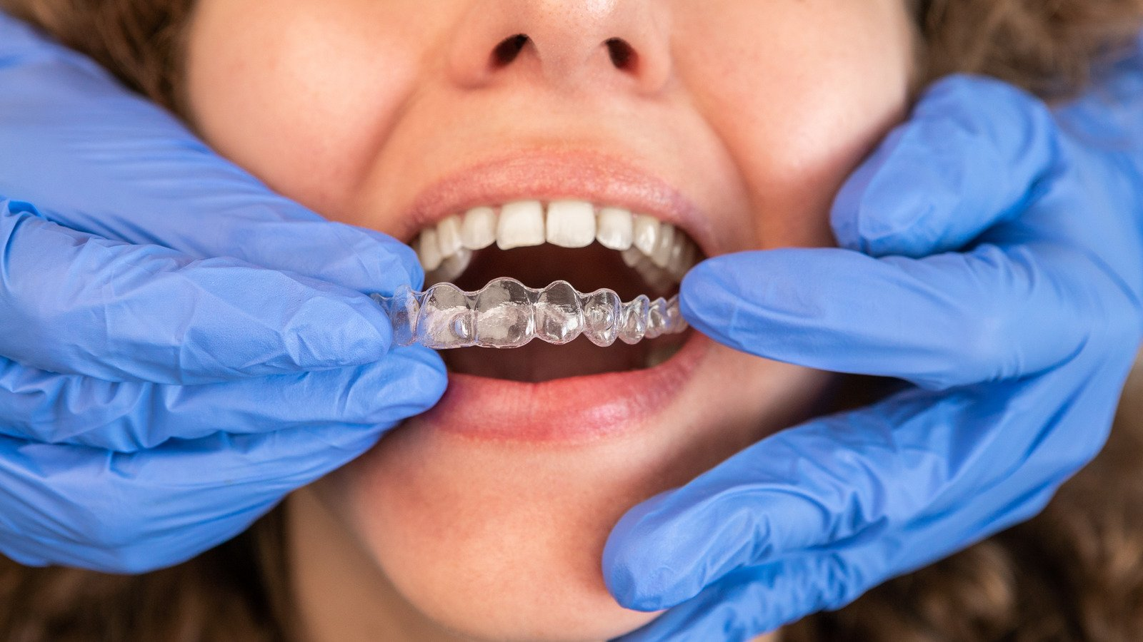 An orthodontist placing clear alginers in a patient's mouth