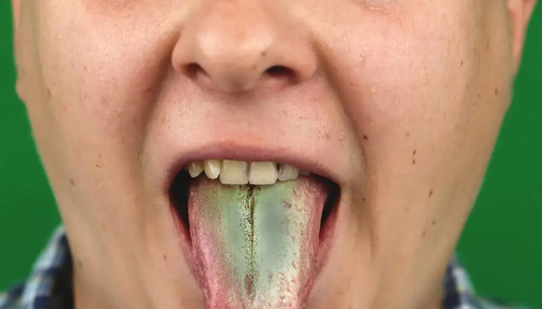 Grønn tunge – Hva det betyr og hvordan behandle det 15 "Person viser tunge med grønnaktig belegg og misfarging som kan tyde på infeksjon eller sopp."