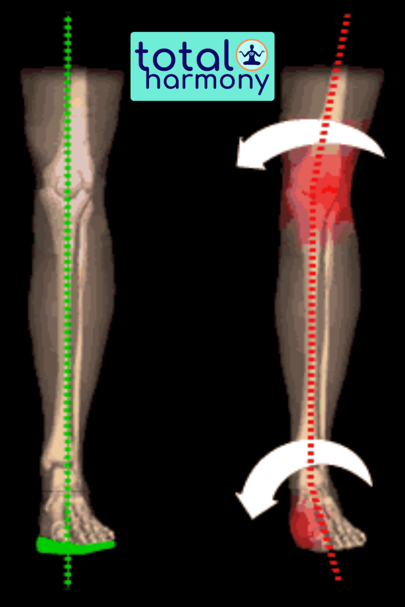 plantar fascia  and knee pain due to poor alignment of foot and leg biomechanics