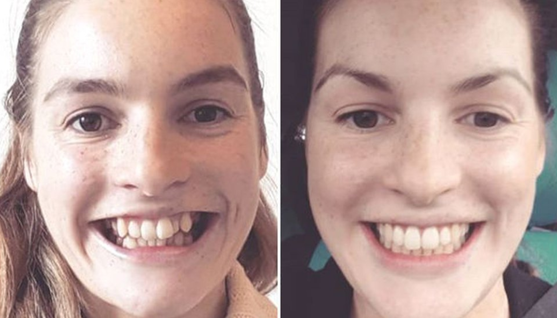 Overbitt og regulering – alt du bør vite før behandling