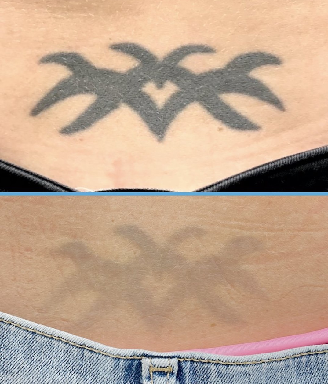 Tattooentfernung mittels Laser