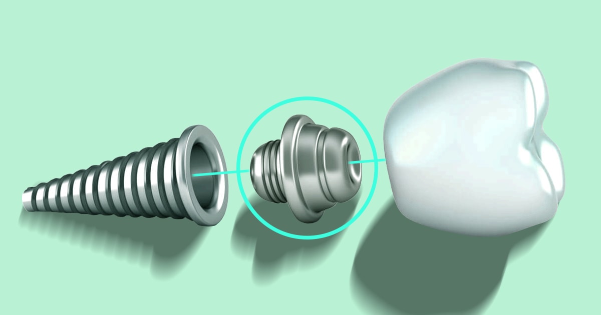 Image showing what a healing abutment looks like