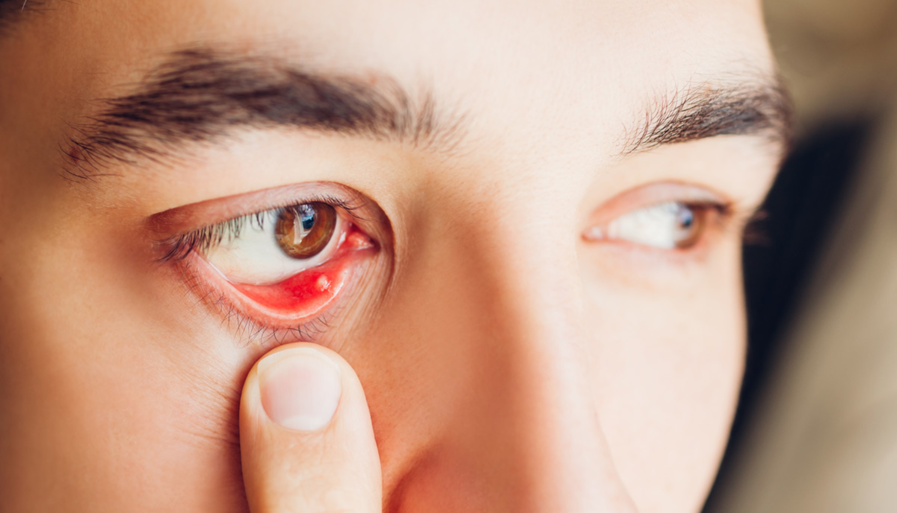 Øye med tegn på tretthet og stress, tydelig rødhet rundt øyelokket.