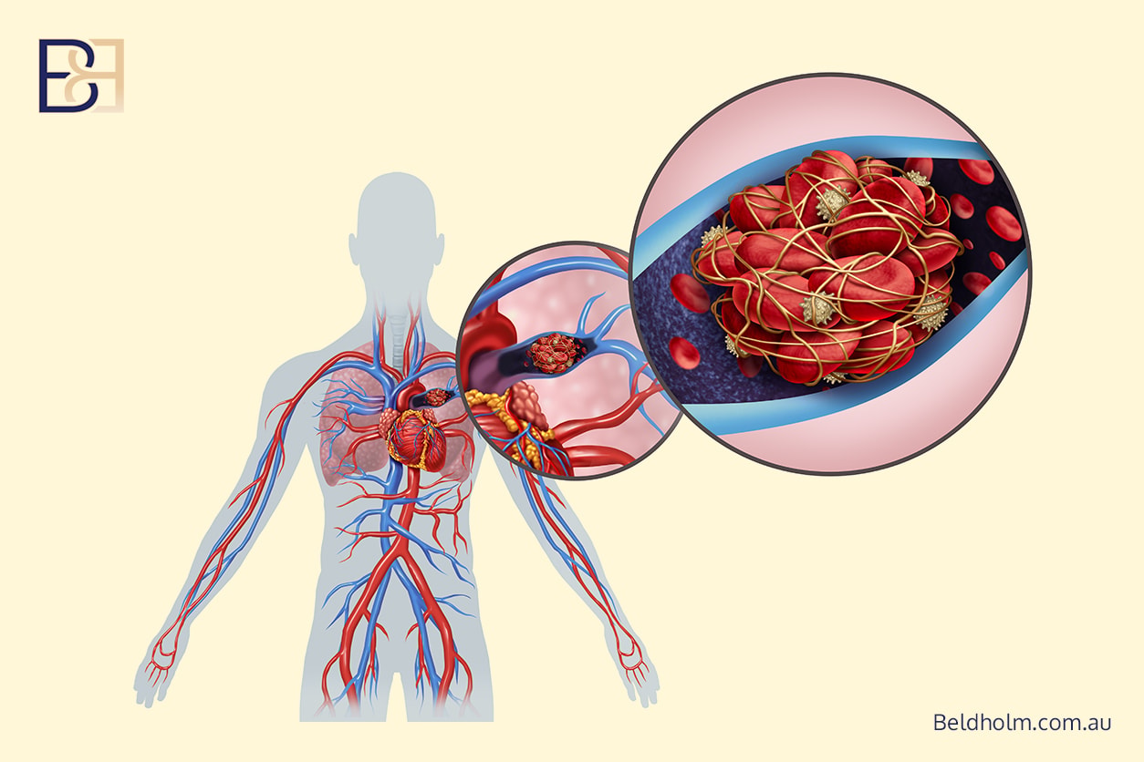 Pulmonary emboli
