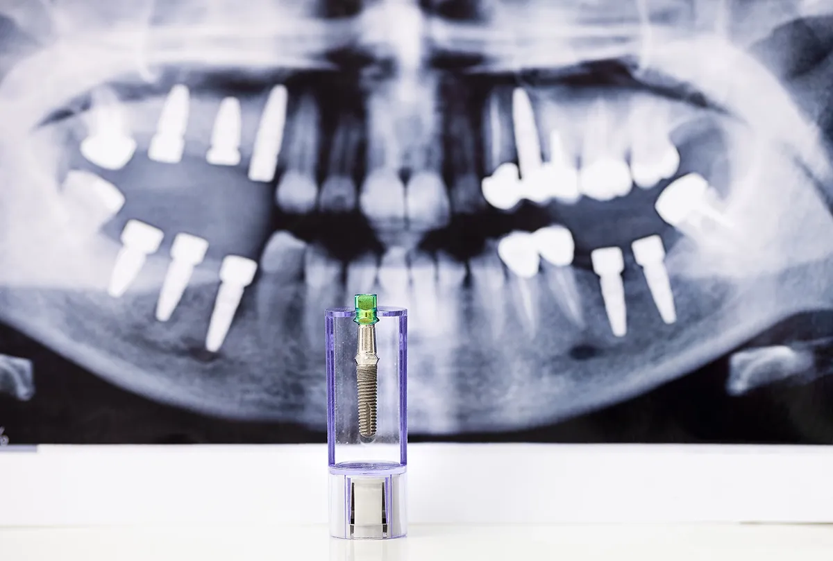 Dental implant screw displayed in transparent container against panoramic dental X-ray showing multiple implants and restorations.