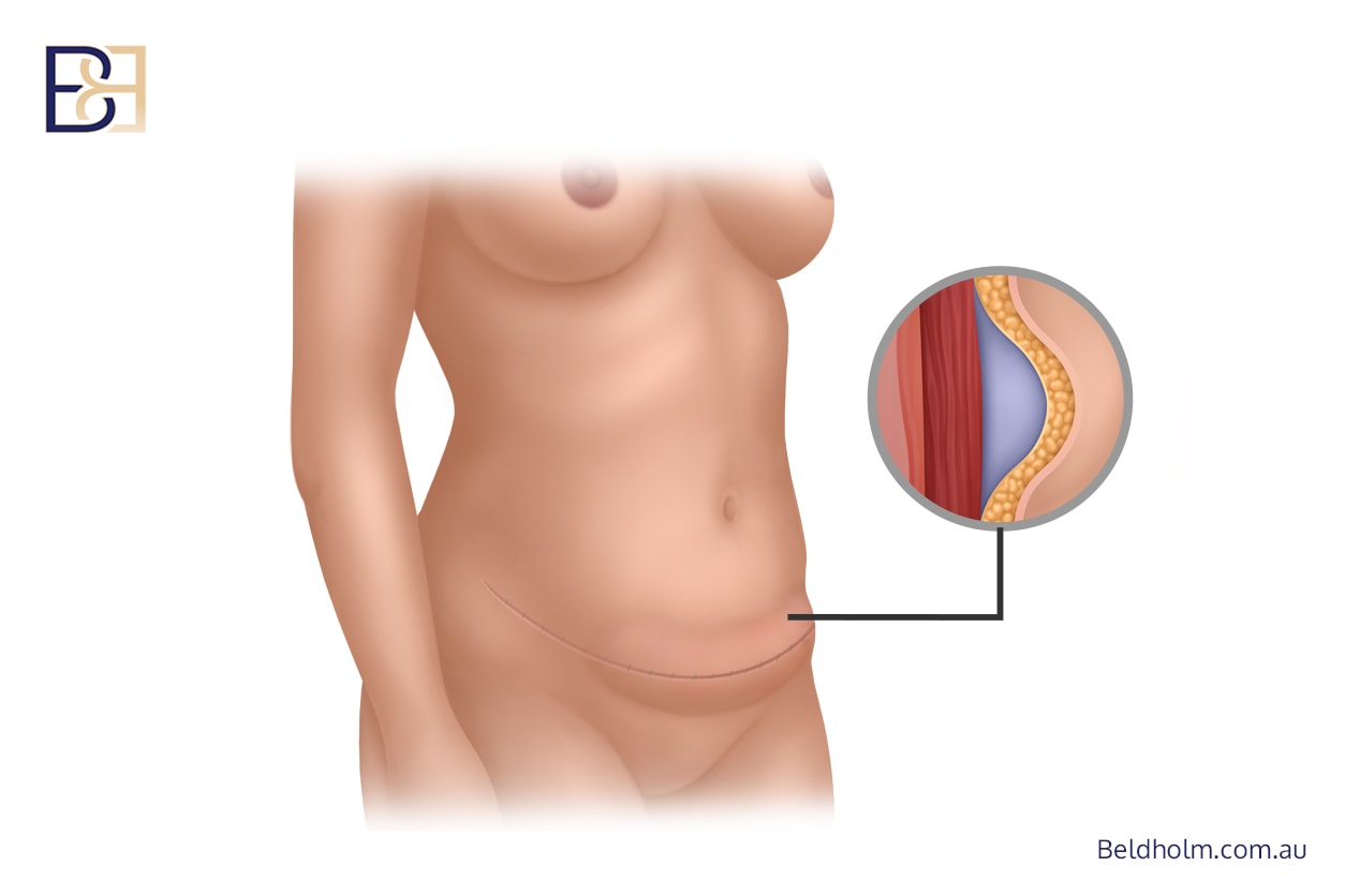 Complications from Bra Lift (Upper Back Lipectomy) post weight loss 4 be044911 262a 480f 8fcd b8d03ea4f034