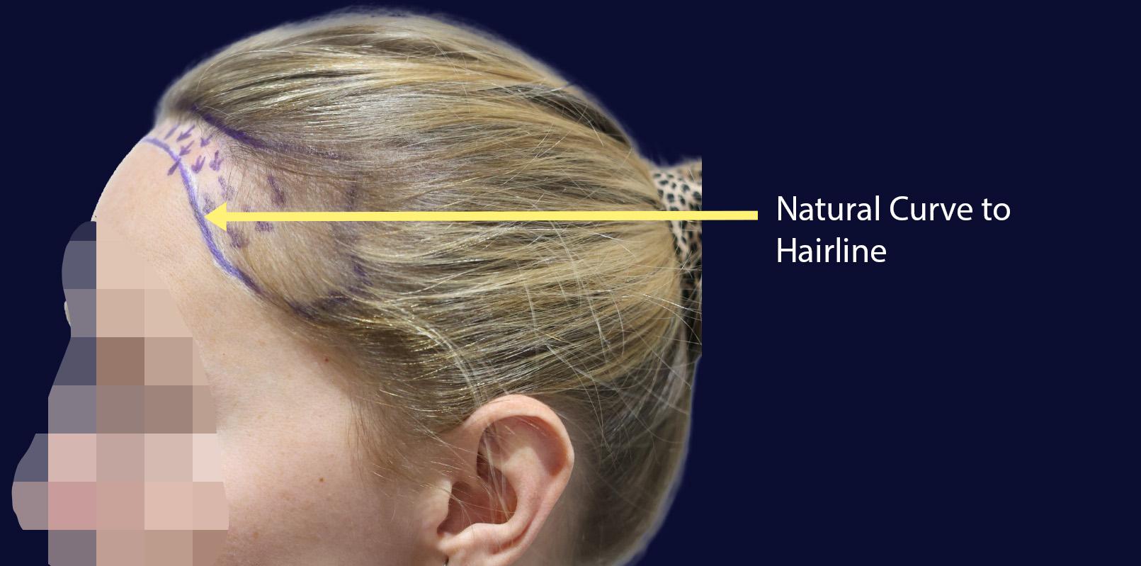 Dr Kunnure Clinic- Hair Transplant - Hairline Design
