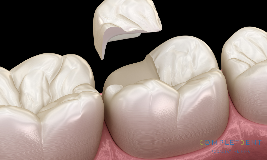 A fogbetétek előnye, hogy a fog egészséges része megmarad