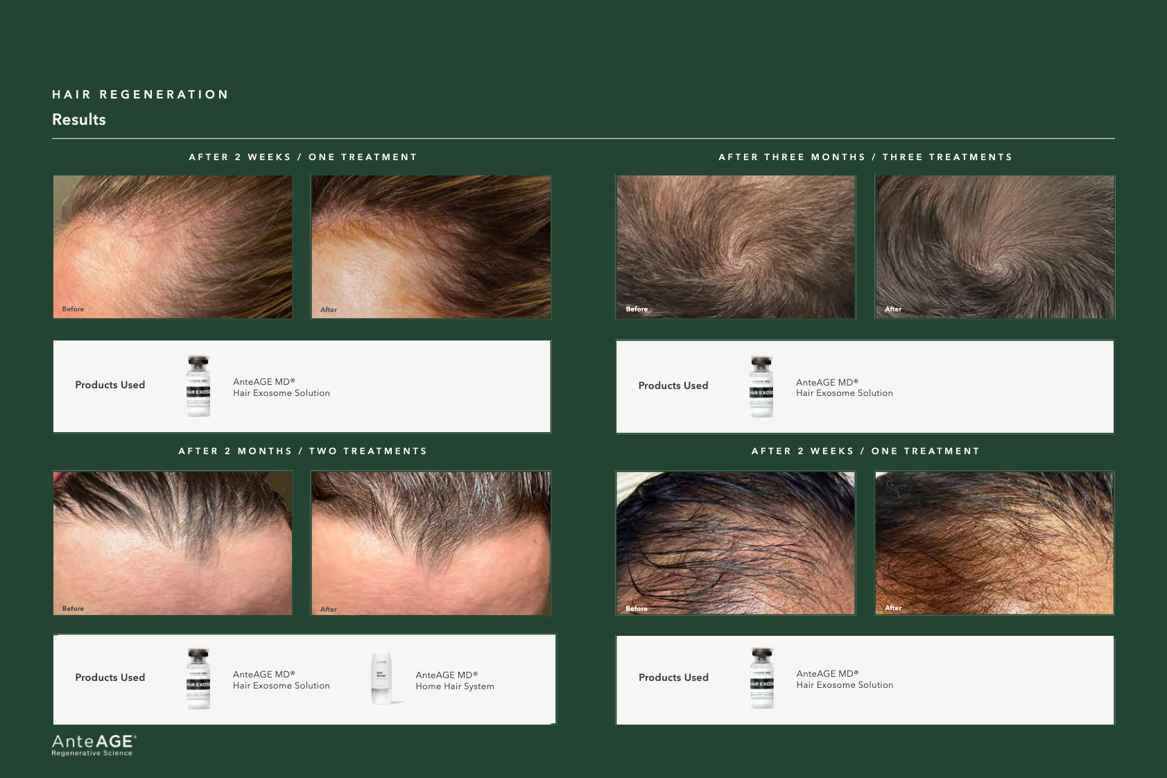 A step-by-step infographic of an exosome hair restoration procedure.