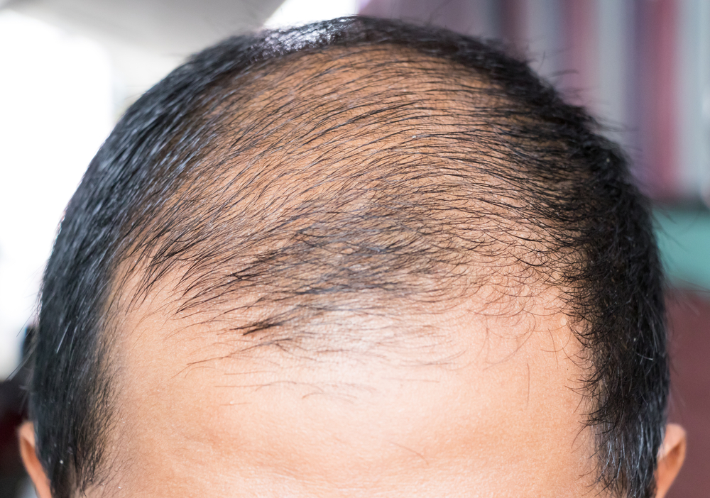Man with thinning hair and receding hairline