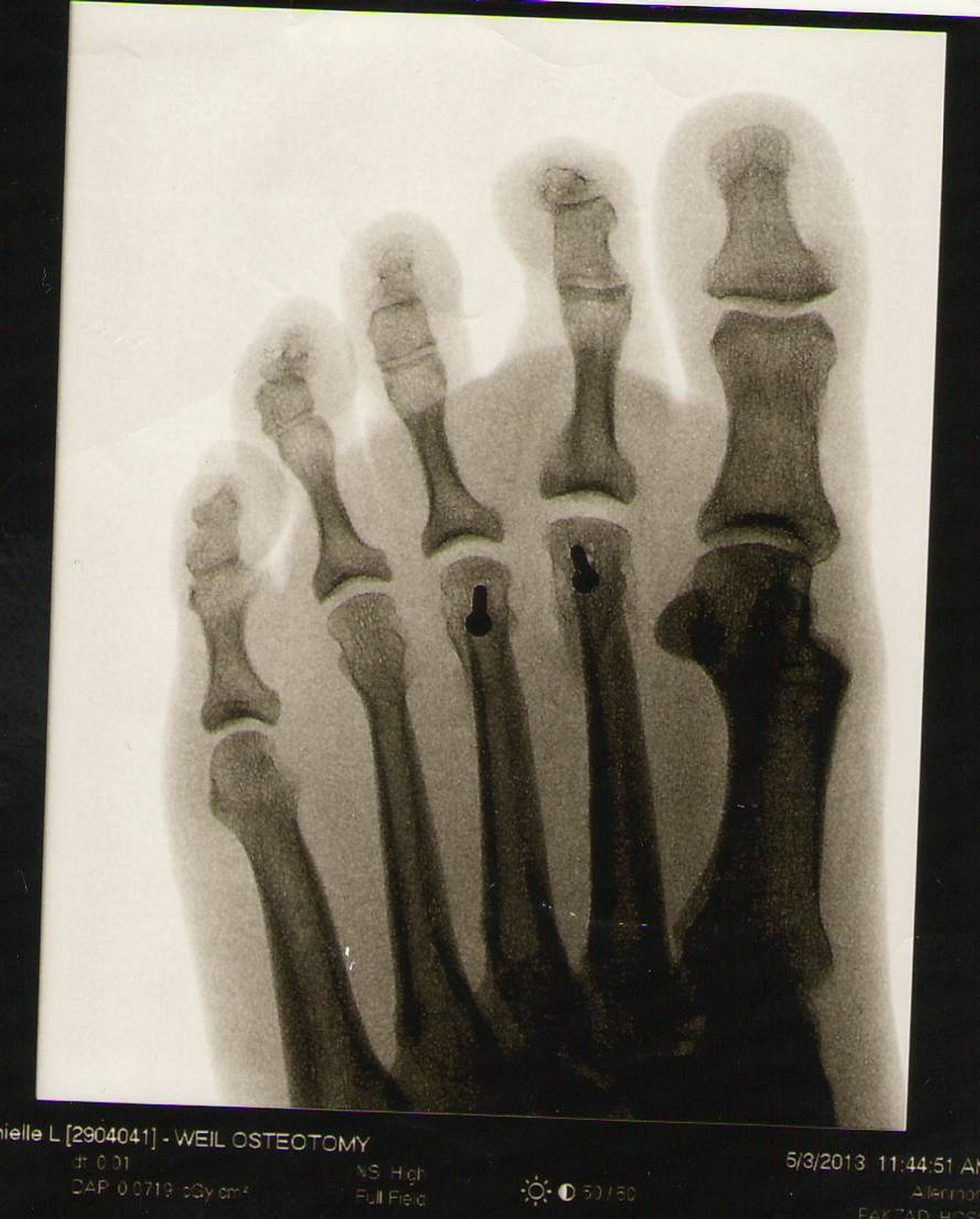 Hälsporre diagnostiseras vanligtvis med hjälp av röntgen av foten.