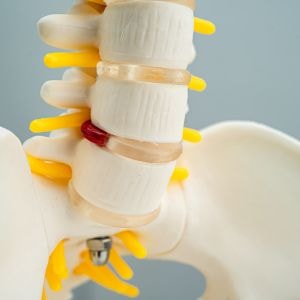 model of a chiropractic subluxation effecting muscles, bones 