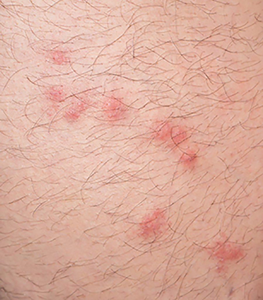 An image of a skin reaction to a flea bite.