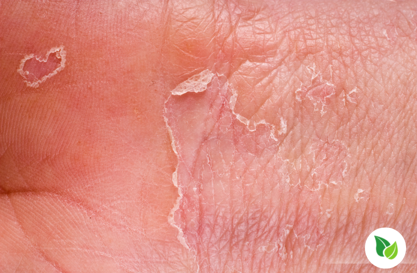 Peeling skin on a foot in a post about Foot Skin Peeling