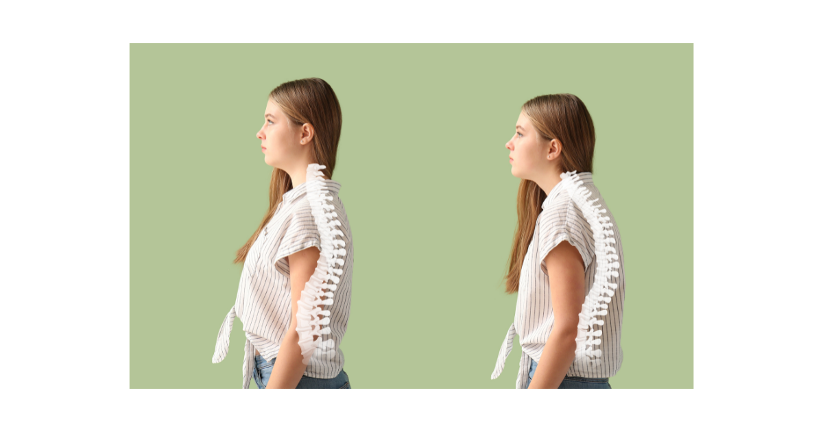 two images of a girl standing with good posture and the showing her stand with poor forward posture which leads to back pain