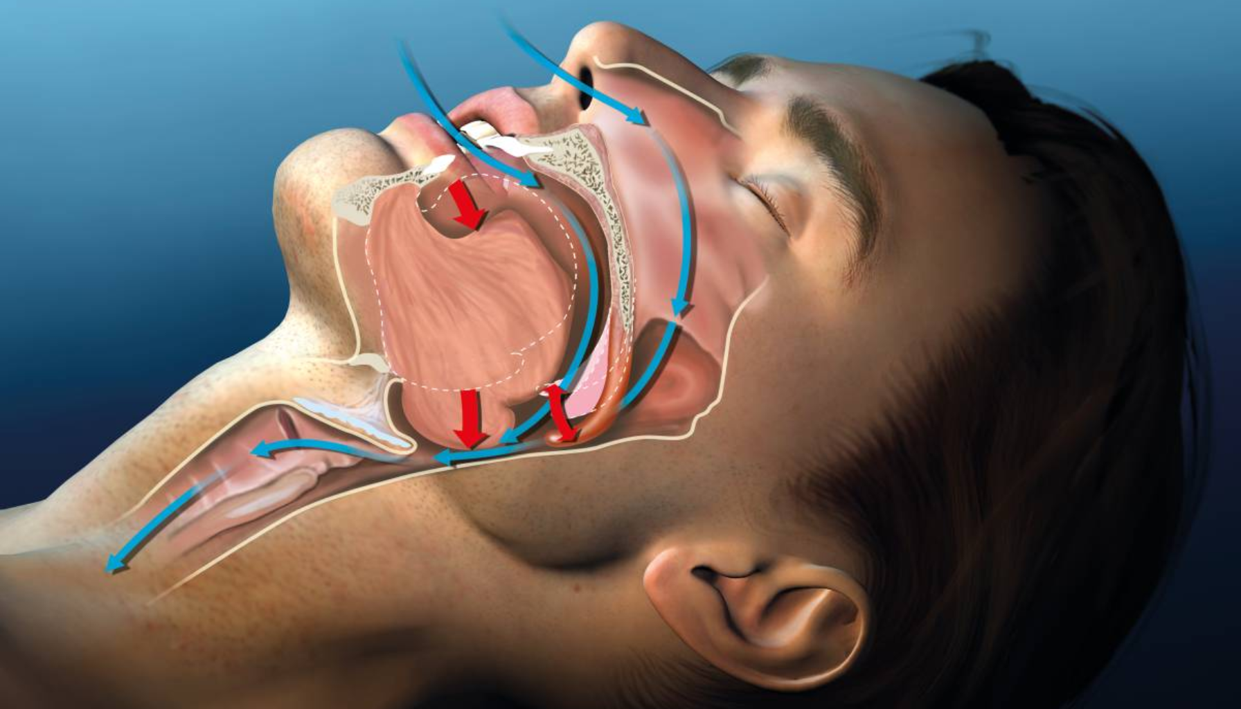 Snorkeoperasjon: Hva betyr det for tannhelsen? 16 "Medisinsk illustrasjon av pust under søvn som viser blokkering i halsen relatert til snorking eller søvnapné." snorkeoperasjon øre nese hals øre nese bløte ganen under søvn snorking behandling ganen søvnapné hos mer under spesialist operasjonen bløte søvn vevet snorker andre mindre inngrep dersom behandlingen luftveiene gir effekt reduserer operasjon minutter flere risiko effektiv fører tar time pasienten pasienter hjelp god ofte lokalbedøvelse første alvorlige lege tre mennesker gjør snorkingen utføres brukes bruker hele kirurgi
