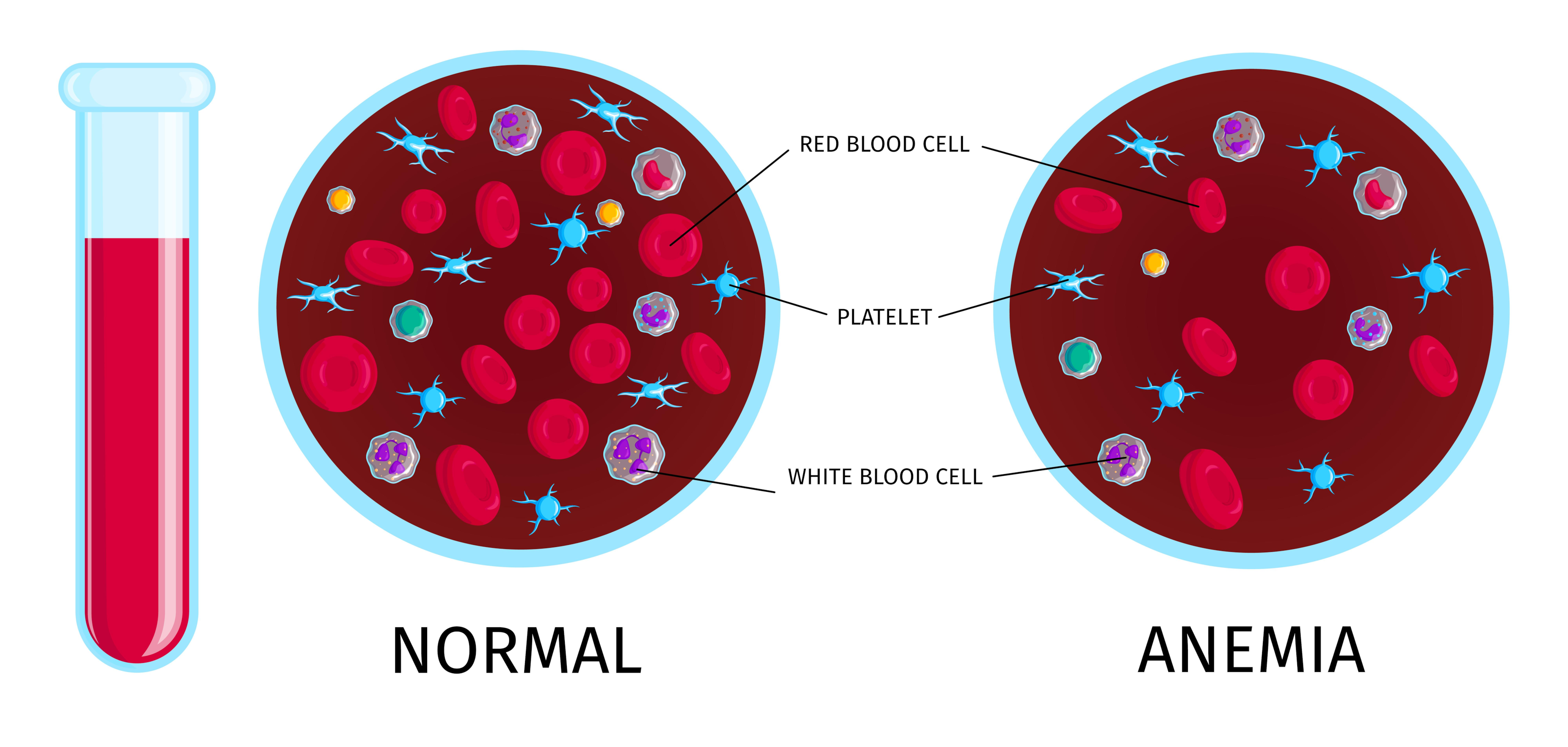 what-are-the-three-stages-of-iron-deficiency