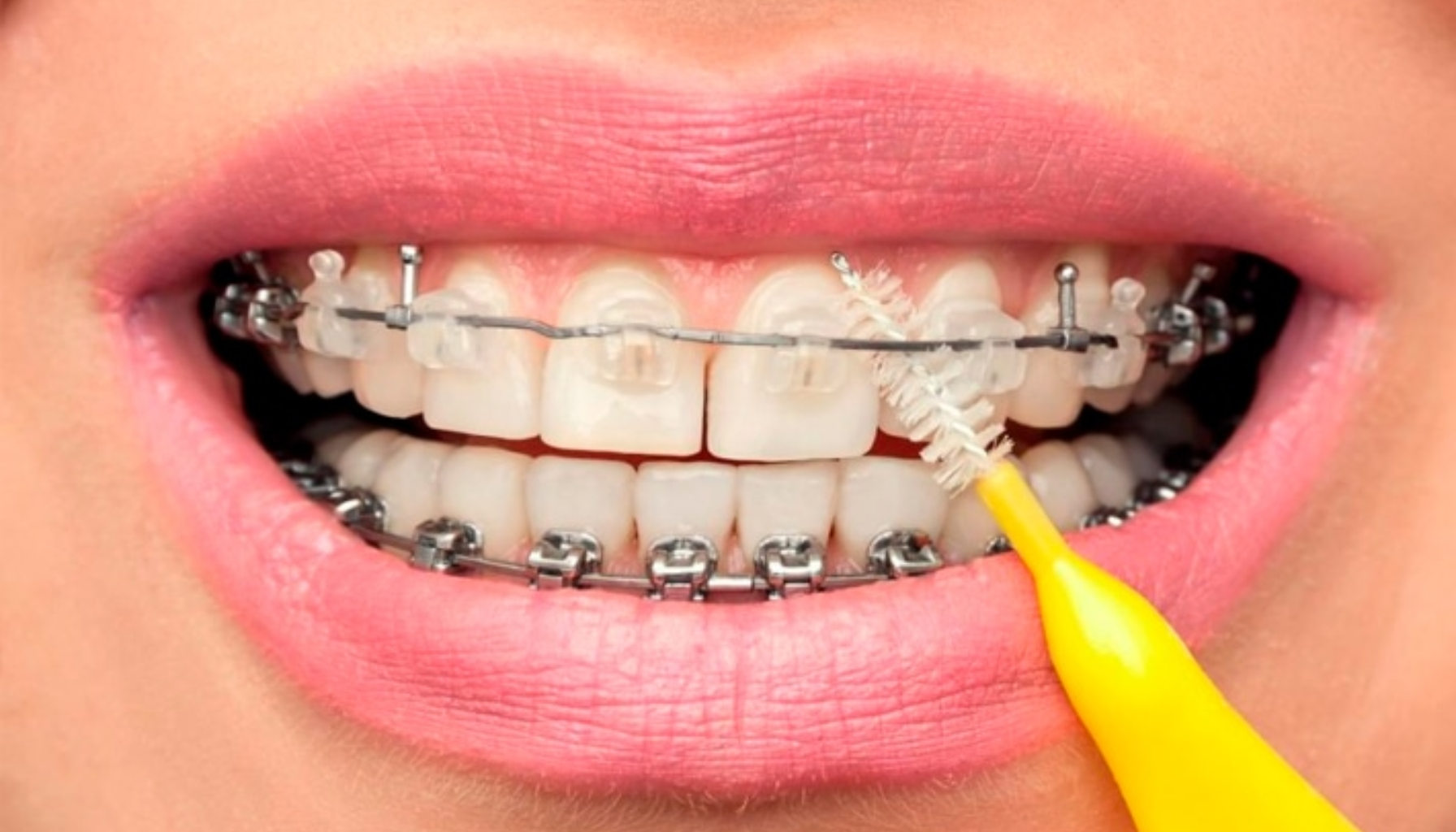 Nærbilde av person som rengjør tannregulering med en liten gul mellomromsbørste for god munnhygiene.