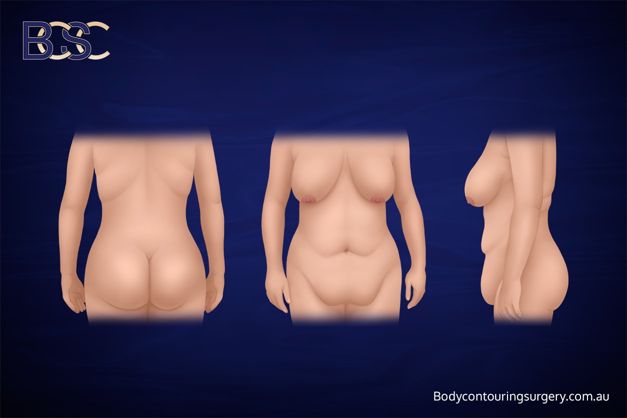 Loose skin after weight loss | Body Contouring Surgery Clinic