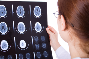 Traumatic brain injuries