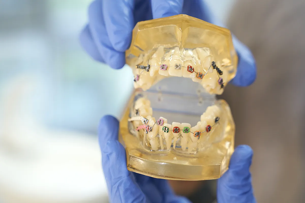 A yellow dental model with colorful braces held by someone in blue gloves