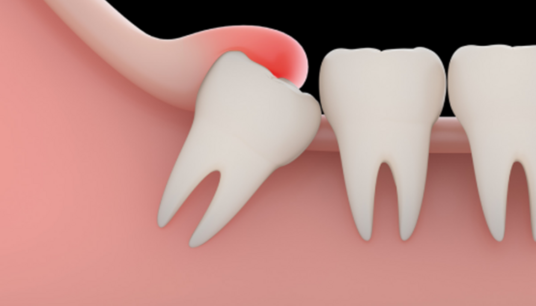 Illustrasjon av retinert visdomstann som vokser skjevt og presser mot nabotann, med betent tannkjøtt rundt.