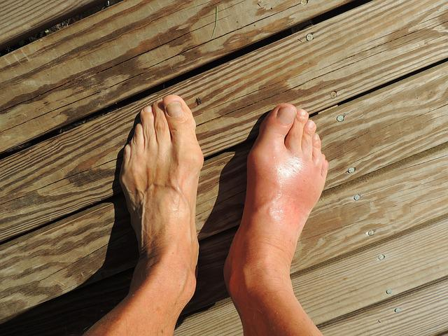 feet, gout, pain