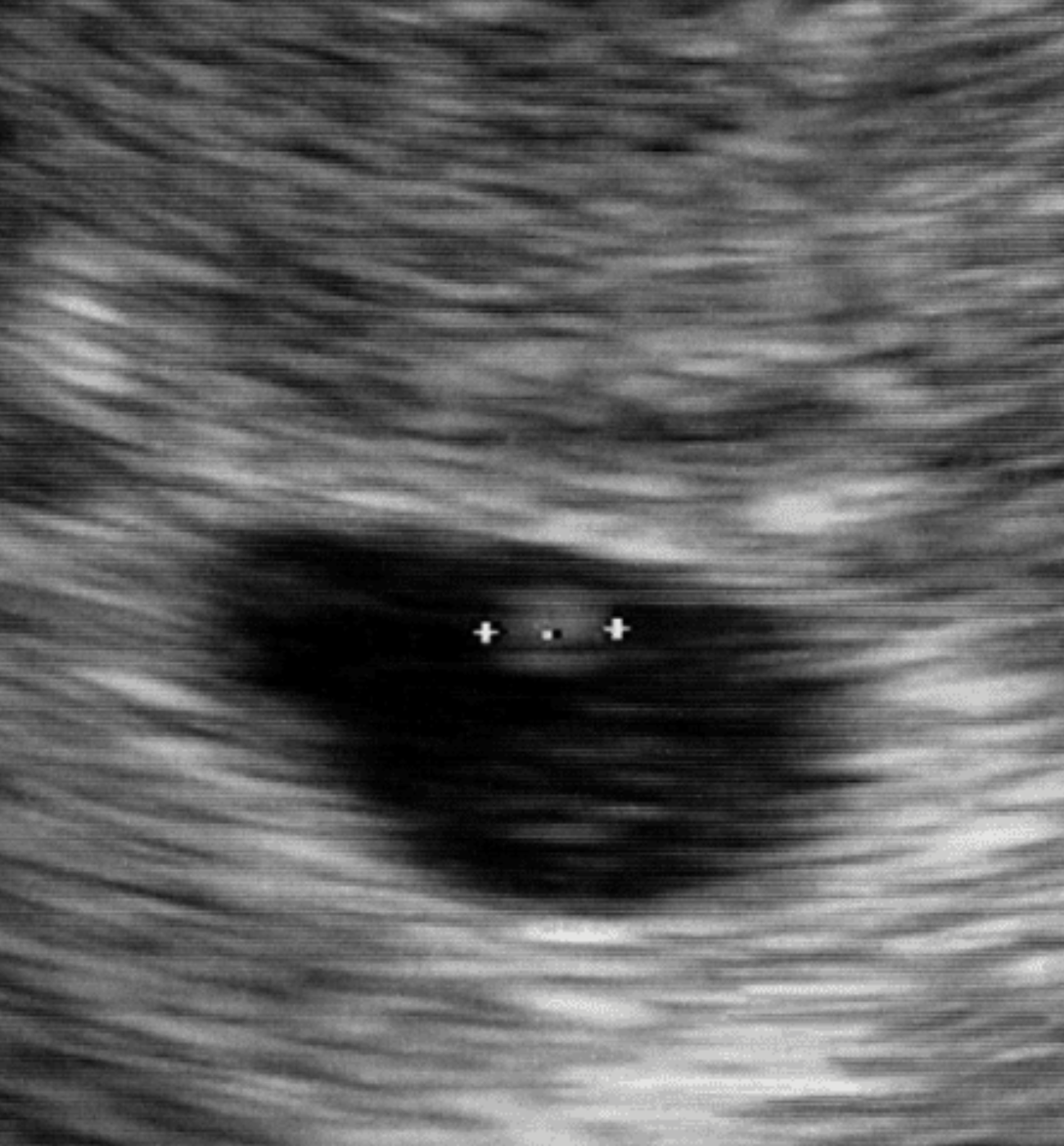 5 week ultrasound scan