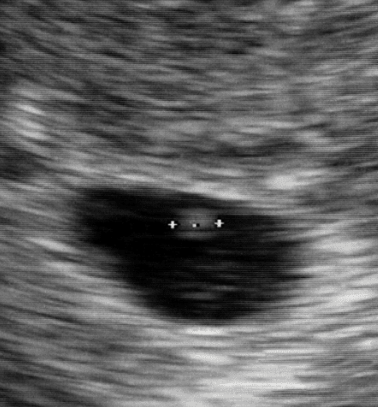 5-weeks-pregnant-ultrasound-showed-nothing-3-reasons-why-pregnant