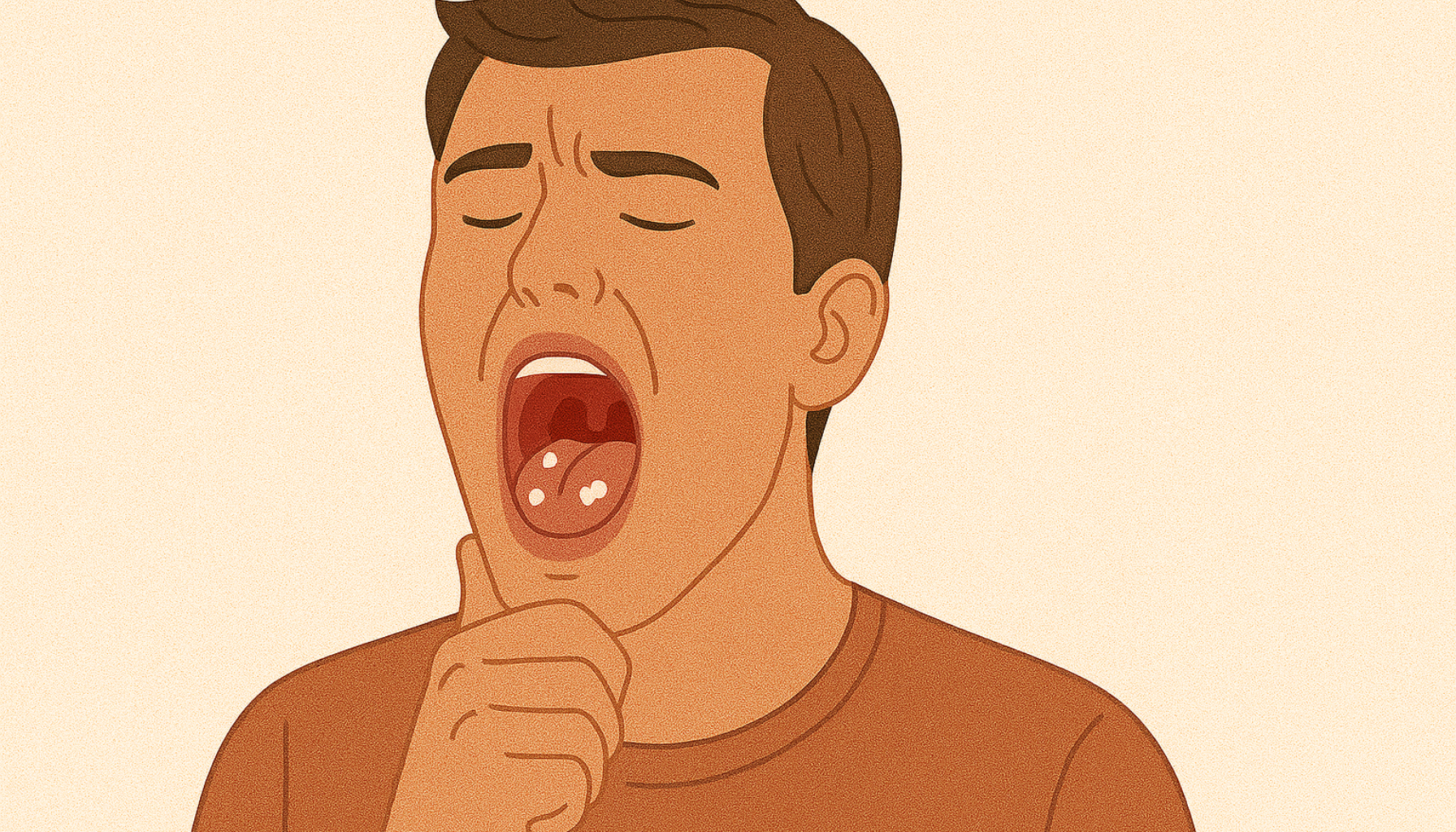 Mann med åpen munn viser hvite klumper på mandlene, illustrasjon av tonsillitt og tonsillesteiner.